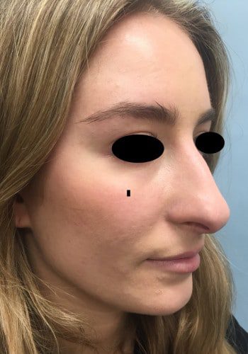 Before Image: Rhinoplasty - right-front-oblique