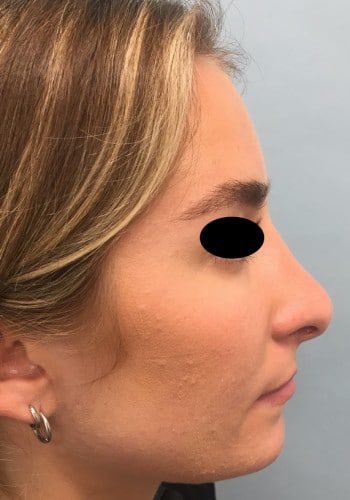 After Image: Rhinoplasty - right-side
