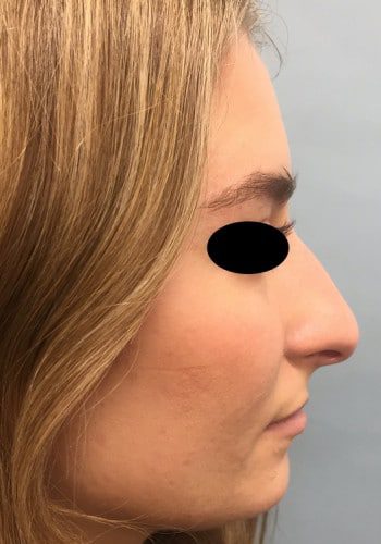 Before Image: Rhinoplasty - right-side