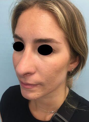 After Image: Rhinoplasty - left-front-oblique
