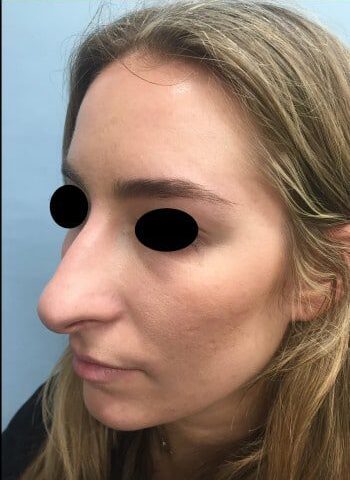 Before Image: Rhinoplasty - left-front-oblique