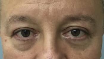 After Image: Blepharoplasty - front