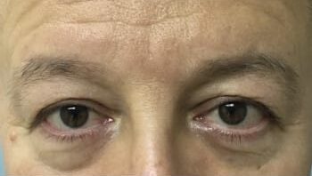Before Image: Blepharoplasty - front