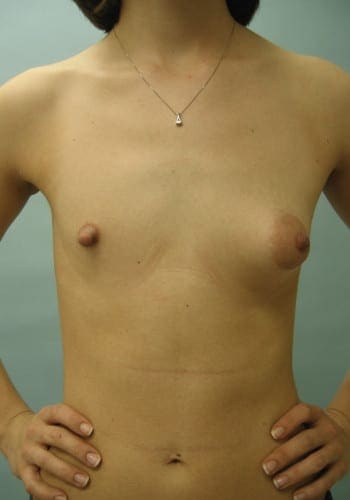 Before Image: Asymmetric Breasts - front