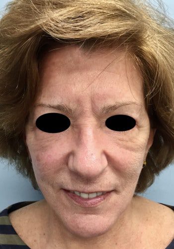 After Image: Facelift, Blepharoplasty - front