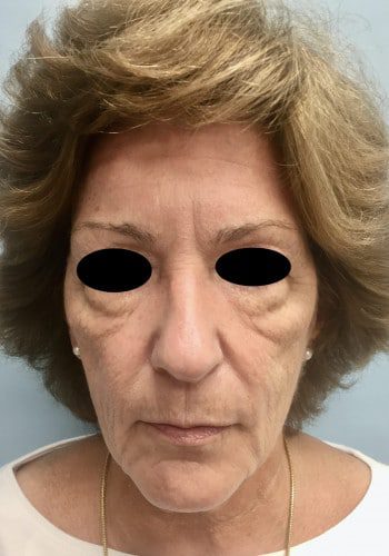Before Image: Facelift, Blepharoplasty - front