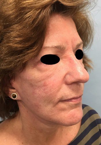 After Image: Facelift, Blepharoplasty - right-front-oblique