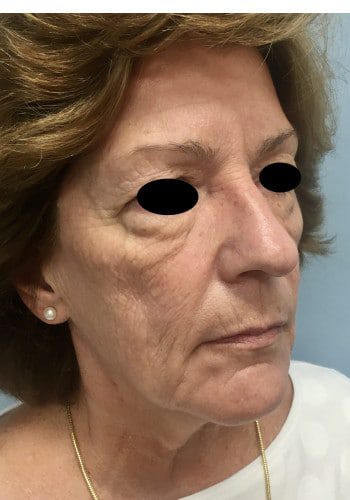Before Image: Facelift, Blepharoplasty - right-front-oblique