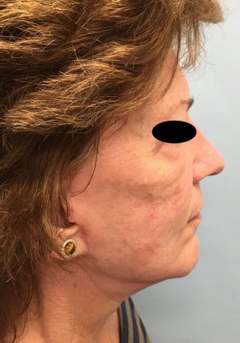 After Image: Facelift, Blepharoplasty - right-side