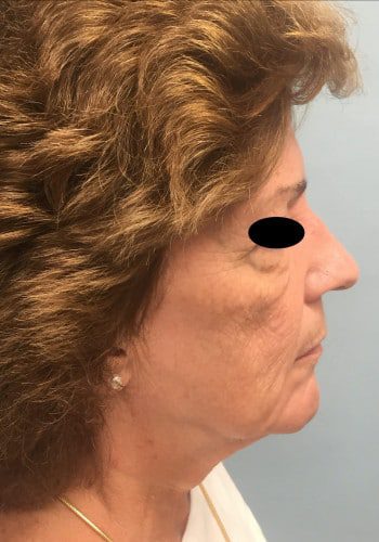 Before Image: Facelift, Blepharoplasty - right-side