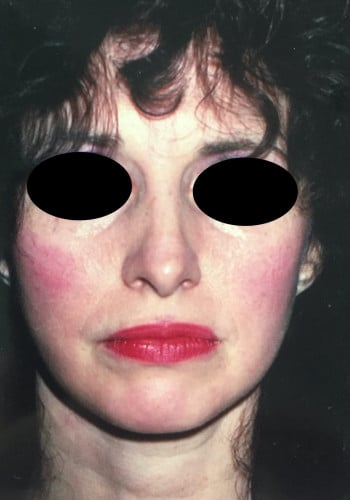 After Image: Facelift, Blepharoplasty - front