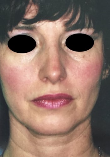 Before Image: Facelift, Blepharoplasty - front