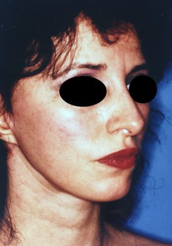 After Image: Facelift, Blepharoplasty - right-front-oblique