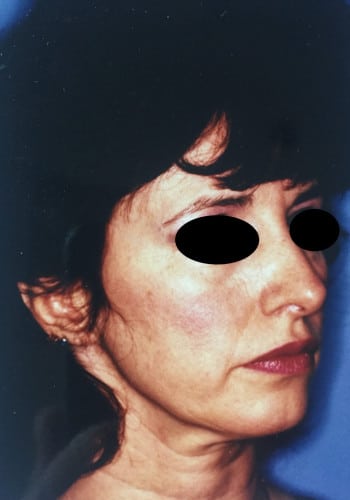 Before Image: Facelift, Blepharoplasty - right-front-oblique