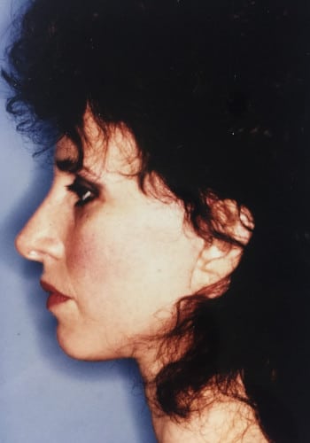 After Image: Facelift, Blepharoplasty - left-side