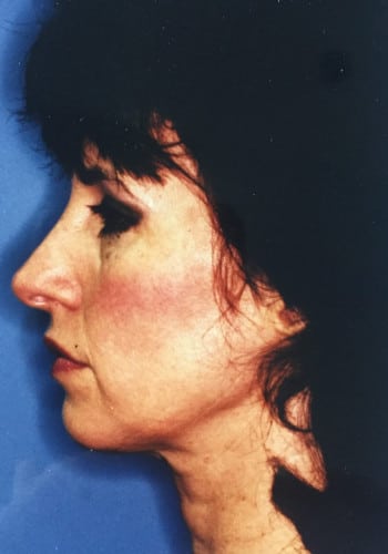 Before Image: Facelift, Blepharoplasty - left-side