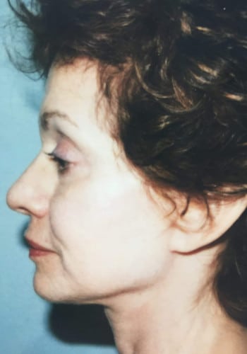 After Image: Facelift, Blepharoplasty - left-side