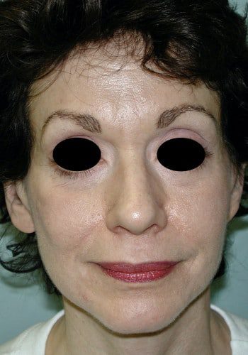 After Image: Facelift, Blepharoplasty - front