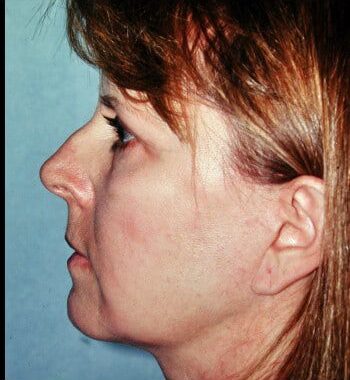After Image: Facelift, Blepharoplasty, Browlift - left-side