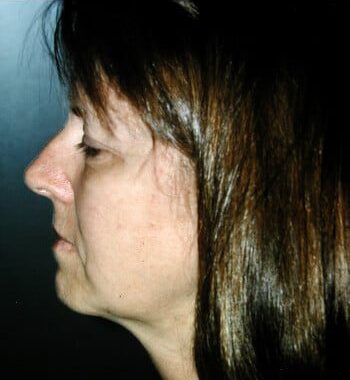 Before Image: Facelift, Blepharoplasty, Browlift - left-side