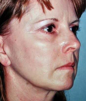 After Image: Facelift, Blepharoplasty, Browlift - right-front-oblique