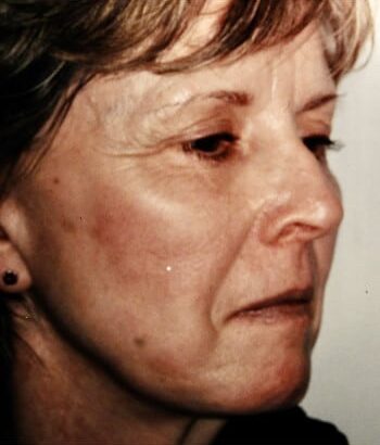 Before Image: Facelift, Blepharoplasty, Browlift - right-front-oblique