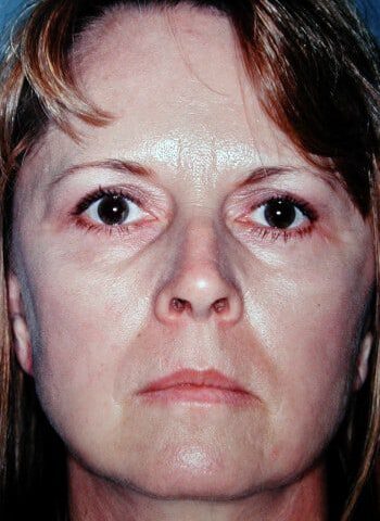 After Image: Facelift, Blepharoplasty, Browlift - front