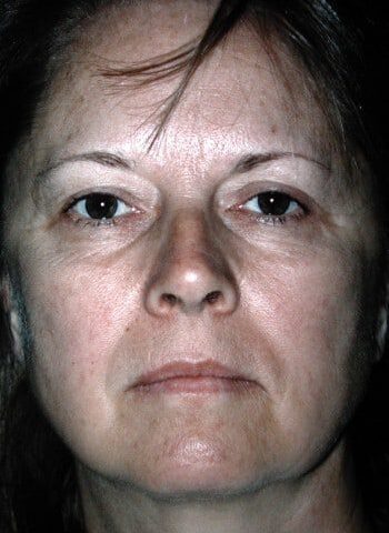 Before Image: Facelift, Blepharoplasty, Browlift - front