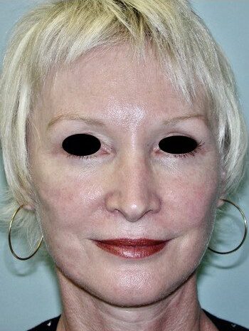 After Image: Facelift, Blepharoplasty, Rhinoplasty - front