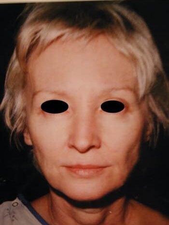 Before Image: Facelift, Blepharoplasty, Rhinoplasty - front