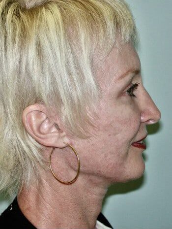 After Image: Facelift, Blepharoplasty, Rhinoplasty - right-side