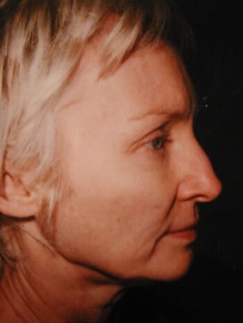 Before Image: Facelift, Blepharoplasty, Rhinoplasty - right-side