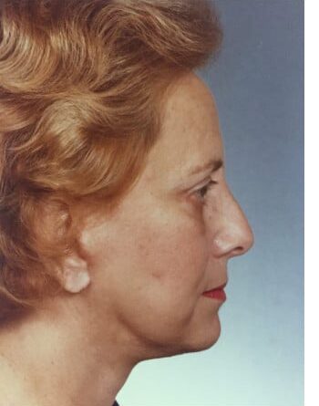 After Image: Facelift and Blepharoplasty - right-side