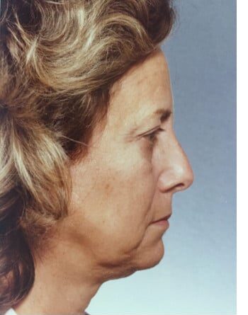 Before Image: Facelift and Blepharoplasty - right-side