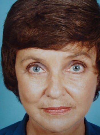 After Image: Facelift, Blepharoplasty - front