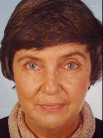Before Image: Facelift, Blepharoplasty - front