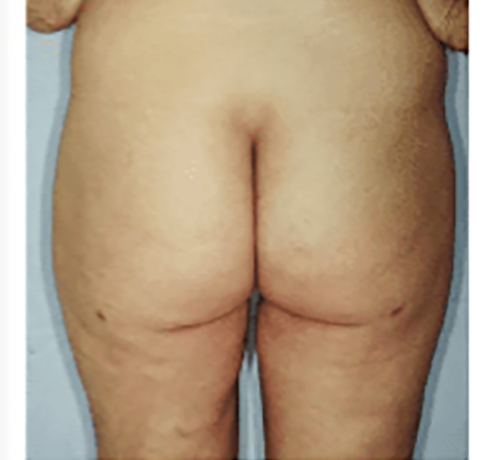 After Image: Liposuction - back