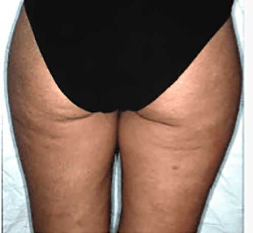 Before Image: Liposuction - back