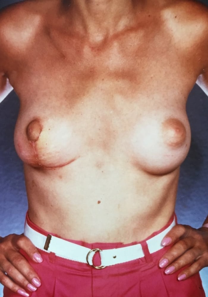 After Image: Asymmetric Breasts - front