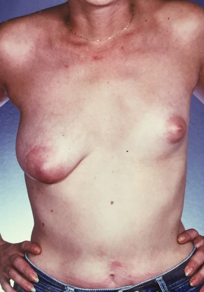 Before Image: Asymmetric Breasts - front