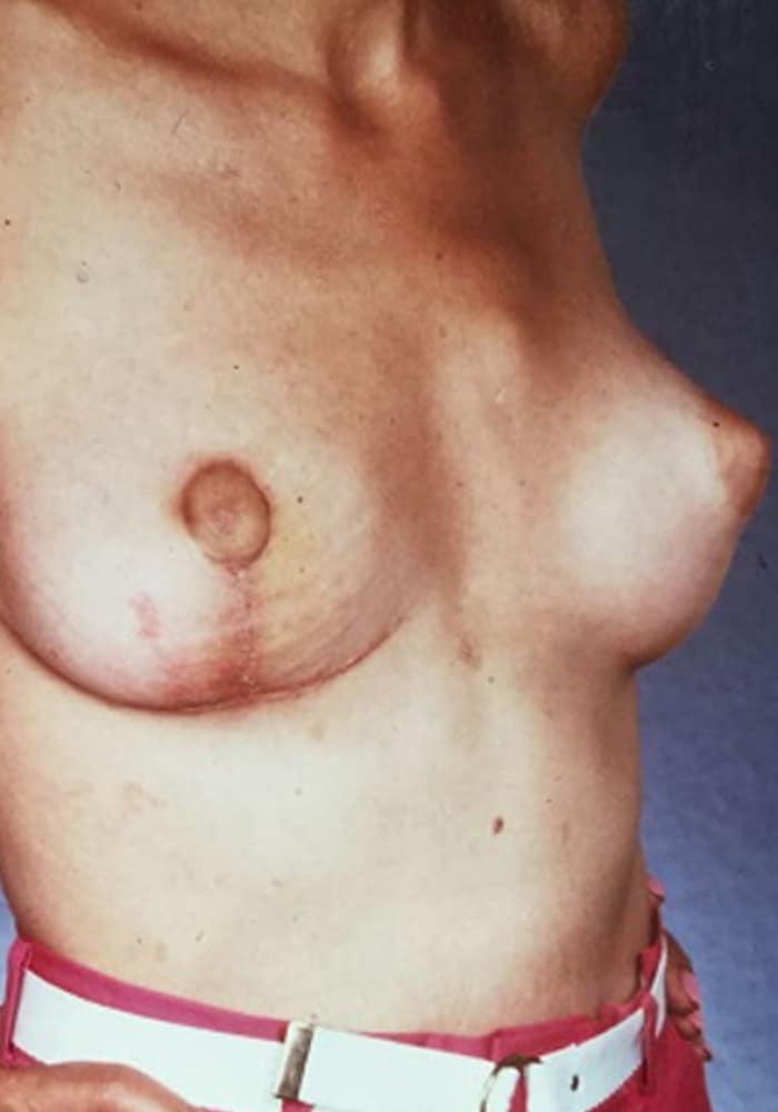 After Image: Asymmetric Breasts - right-front-oblique