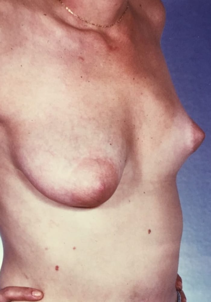 Before Image: Asymmetric Breasts - right-front-oblique