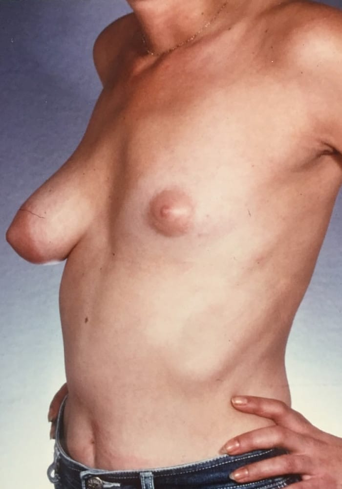 Before Image: Asymmetric Breasts - left-front-oblique