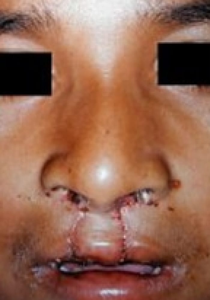 After Image: Cleft Lip - front
