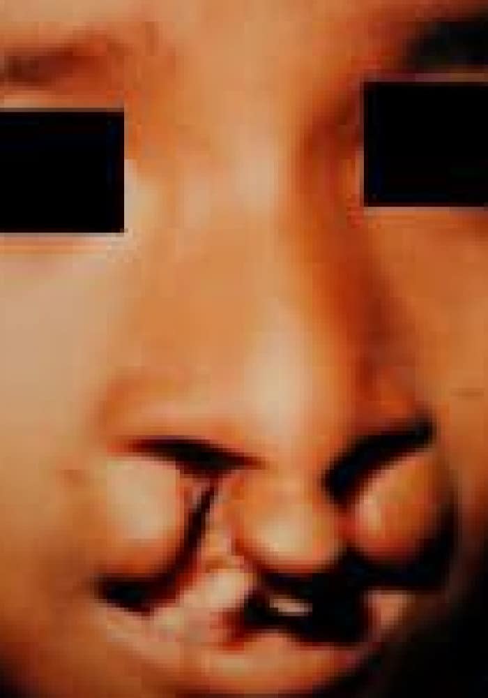 Before Image: Cleft Lip - front