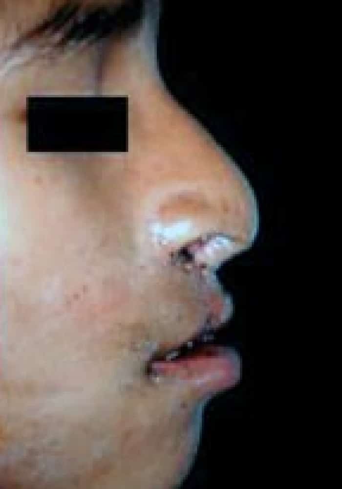 After Image: Cleft Lip - right-side