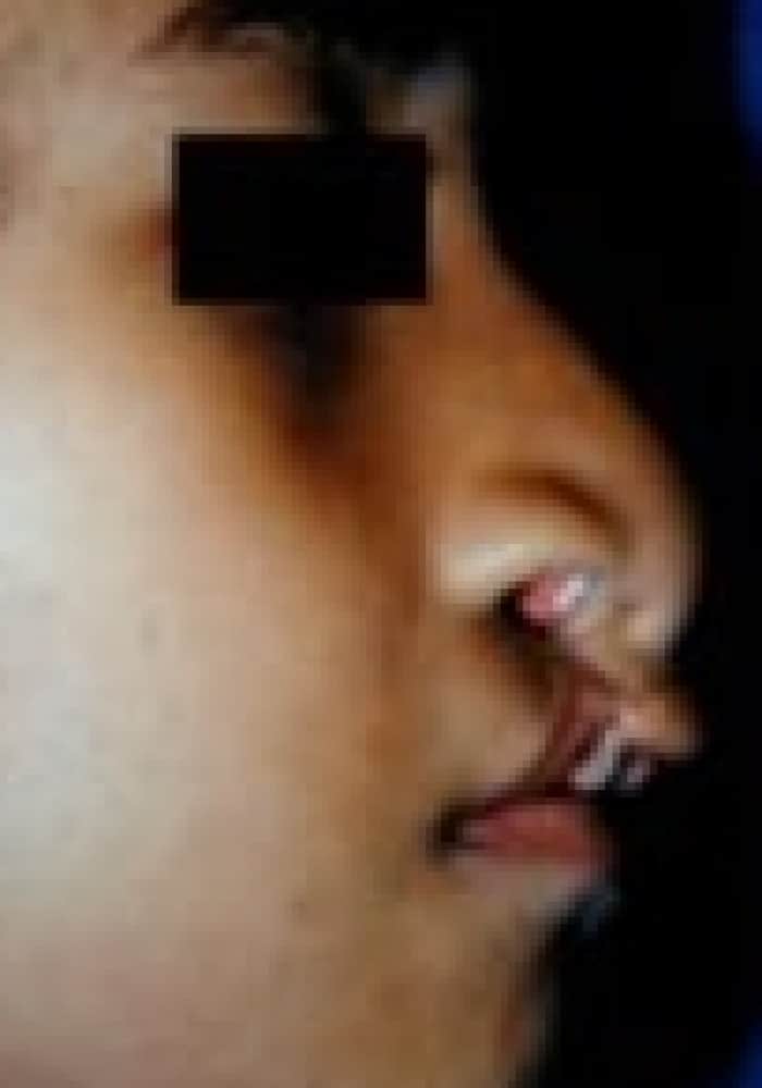 Before Image: Cleft Lip - right-side