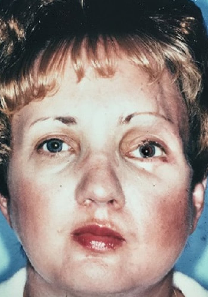 After Image: Cranio Orbital Facial Fracture - front