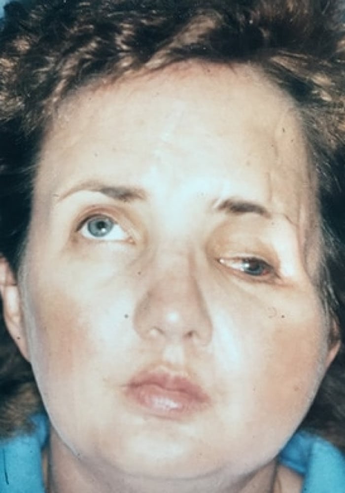 Before Image: Cranio Orbital Facial Fracture - front