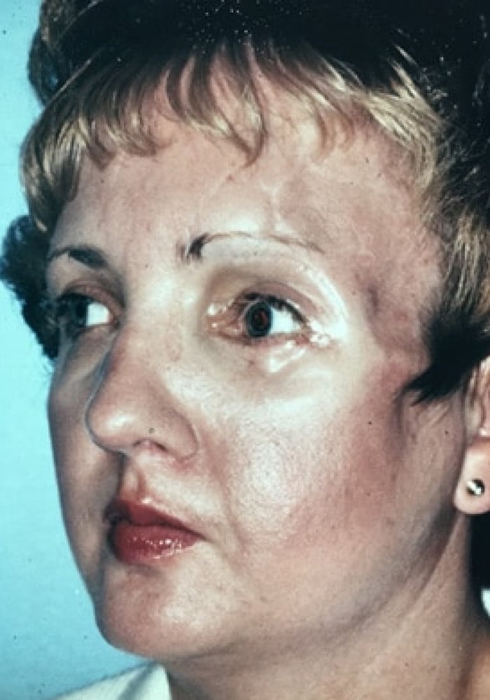 After Image: Cranio Orbital Facial Fracture - left-front-oblique